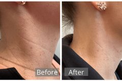 1656103287-neck-filler-1