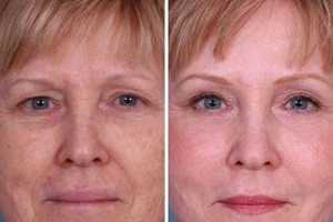 Laser Skin Resurfacing