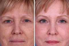 1718914650-laser-skin-resurfacing-1