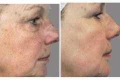 1718914997-laser-skin-resurfacing-4