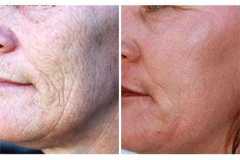 1718915021-laser-skin-resurfacing-6