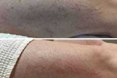 1718915387-laser-vein-removal-2