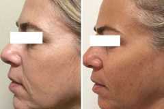 1718756462-microneedling-7