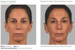 1689369798-sculptra-1