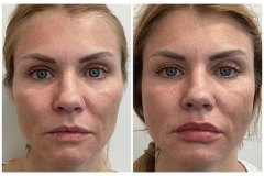 1718909720-sculptra-11