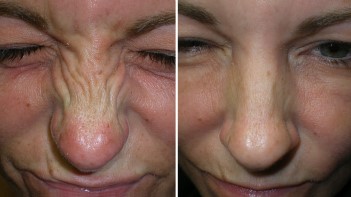 Botox for Bunny Lines – Before and After pictures from Restor Medical Spa, Stapleton, Denver