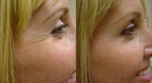 Botox in Crows Feet – Before and After Pictures from Restor Medical Spa, Stapleton, Denver