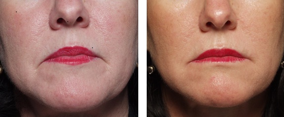 Botox around the Mouth – Before and After Pictures from Restor Medical Spa, Stapleton, Denver