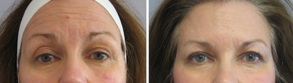 Botox before and after – Forehead lines – Restor Medical Spa, Stapleton, Denver